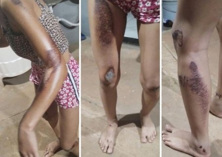 Nova Andradina: Adolescente é atropelada por motociclista que realizava manobras perigosas; Autor fugiu sem prestar socorro e caso revolta familiares.